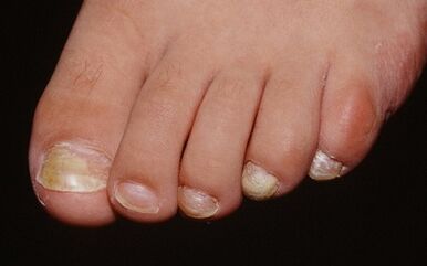 Causes of fungi appearing on the thumb of the leg
