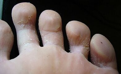 What does fungi look like on the legs and how to treat it