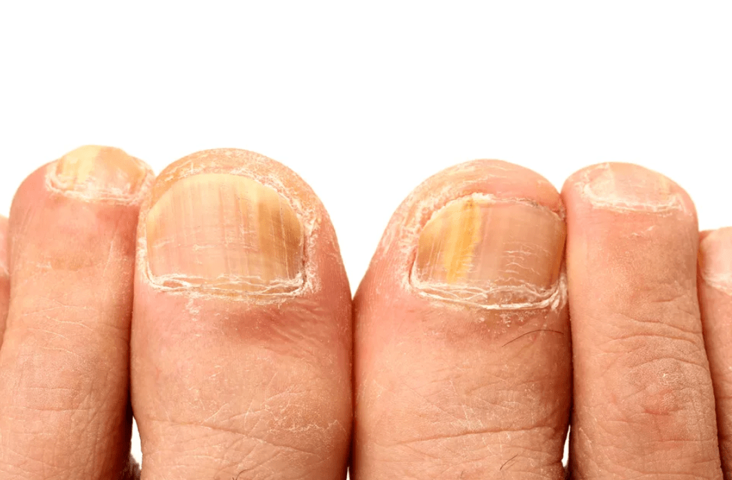 Fungal Disease