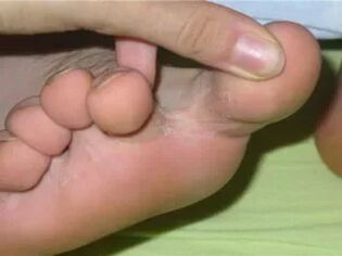 Itchy toes