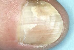 Fungal infection causes deck damage
