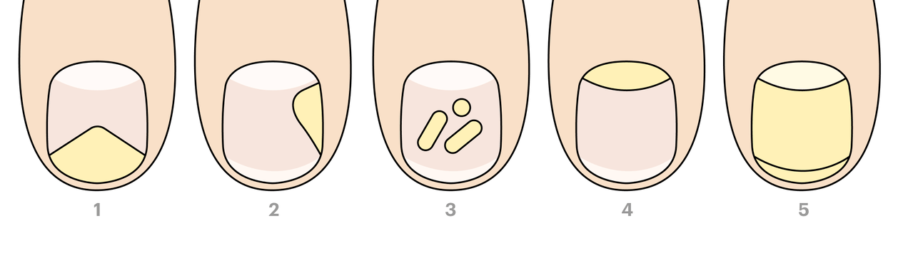 Types of toenail fungus
