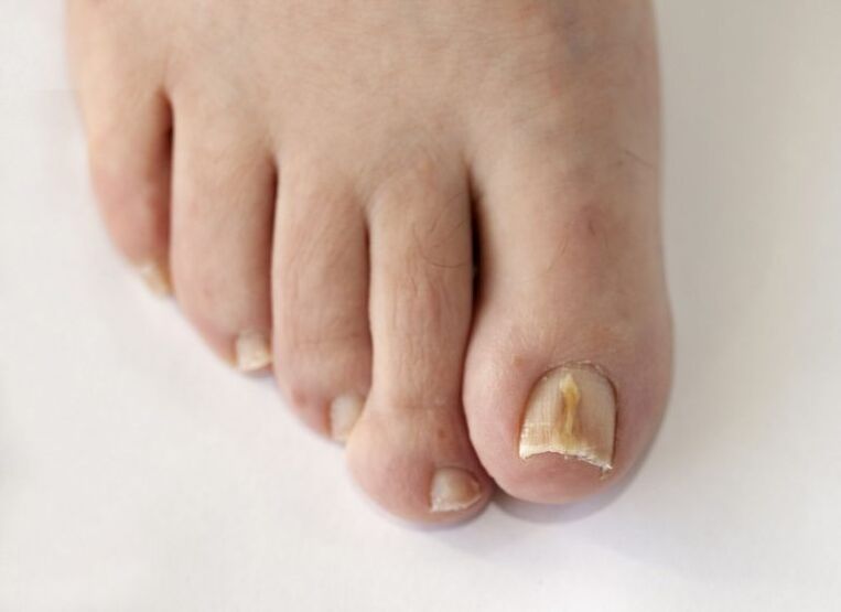 Fungal infection of toe nails