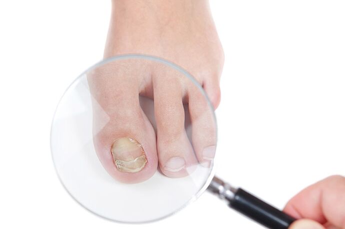 Nail affected by fungus under magnifying glass