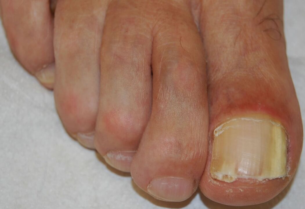 Subungual onychomycosis on distal lateral leg