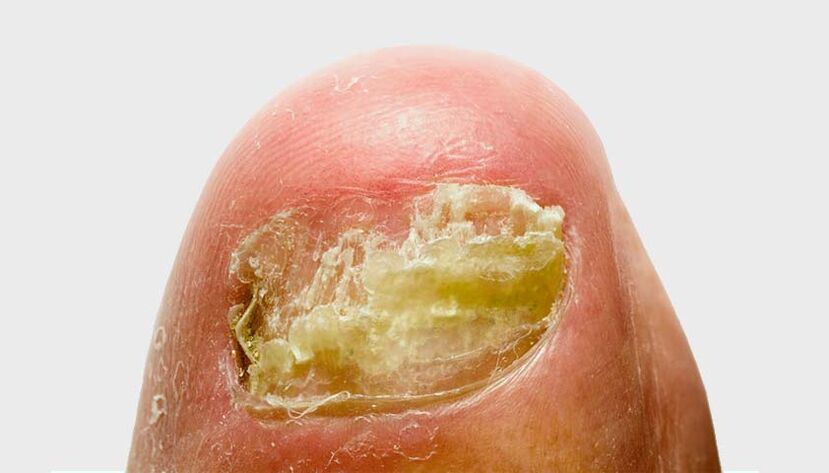 Development stages of onychomycosis